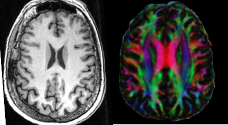 : Researchers like Bendlin and Koenigs use HTC to process data collected in brain imaging scans such as functional magnetic resonance imaging (left) and diffusion tensor imaging (right).

�